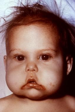This infant presented with symptoms indicative of 