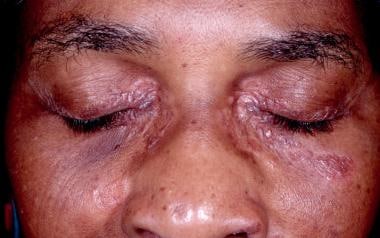 Periocular papules and plaques. 