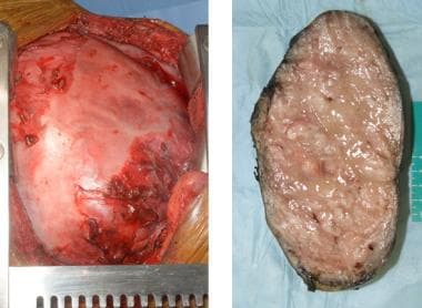 Pathology of nonmesothelial cancers of the pleura.