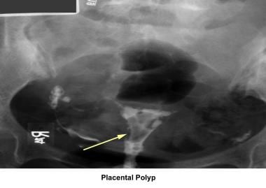 Infertility. Placental polyp. Image courtesy of Ja