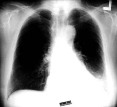 Chest radiograph showing collapse of the left lowe