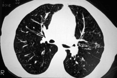 Cystic fibrosis, thoracic. High-resolution CT imag