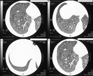 High-resolution CT (HRCT) scans of 50-year-old man