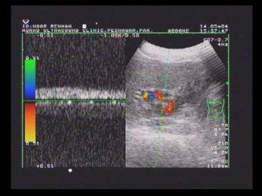 Periportal varices on conventional Doppler and pow