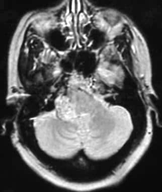 Glomus jugulare tumor. Axial T2-weighted magnetic 