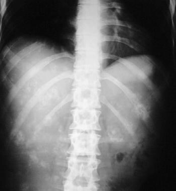 Plain radiograph of the upper abdomen in the same 
