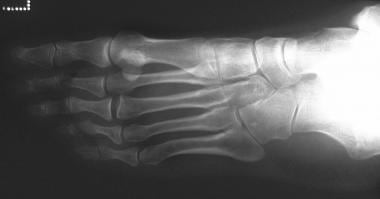 Osteonecrosis of the third metatarsal head (ie, Fr