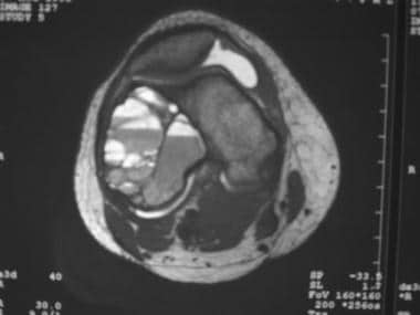 T2-weighted axial MRI of the knee shows multiple f