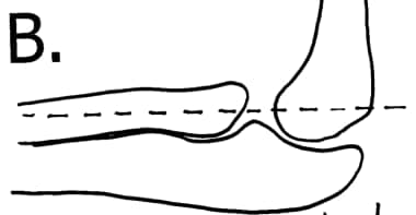 Normal radiocapitellar line drawn down through mid