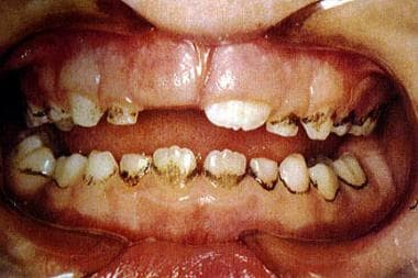 Extrinsic dental staining caused by long-term topi