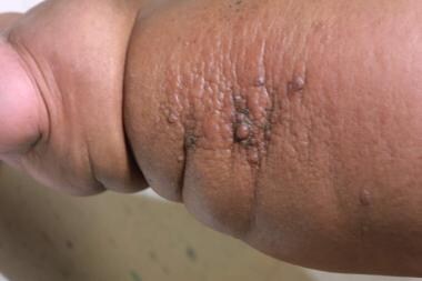 Morbidly obese patient with lymphedema. 