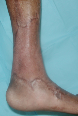 Left lower extremity wound fully healed at 2 years