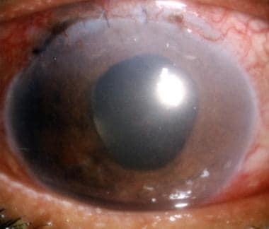 Pseudophakic pupillary block precipitated by leaka
