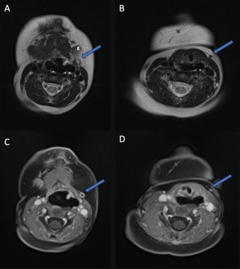 Second branchial fistula. MRI demonstrates a tract