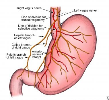 Peptic ulcer disease. Vagal innervation of the sto