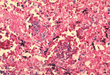 Histopathology of mediastinal lymph node showing a