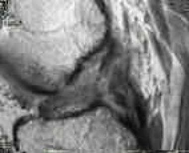 MRI displaying a ruptured anterior cruciate ligame