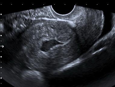 Complex fluid in the uterine canal in a patient wi