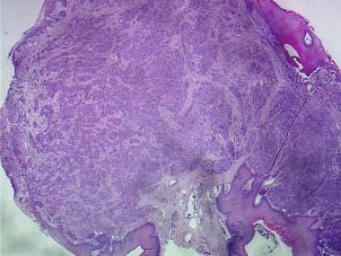 Histologic image of a polypoid mass. Rounded colle