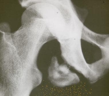 Pelvic apophyseal avulsion fracture of the ischial
