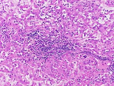 Pathology of Expansile Astrocytomas. Chordoid glio
