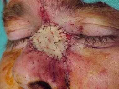 Glabellar and cheek components of the wound have b