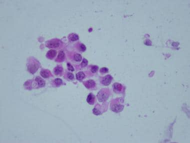 Pathology of Embryonal Tumors. The histology image