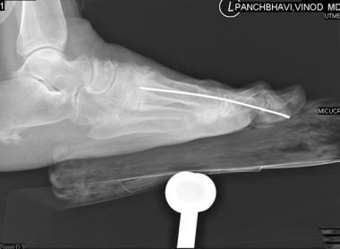 Chevron osteotomy to correct severe hallux valgus