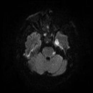 MRI (1.5 Tesla) of the same patient (56-year-old w