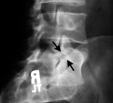 Spondylolisthesis. Oblique projection radiograph s