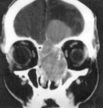 Coronal CT scan of the orbits and sinuses shows a 