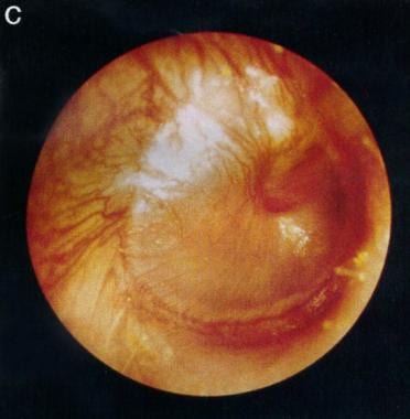 Tympanic membrane of a person with 12 hours of ear