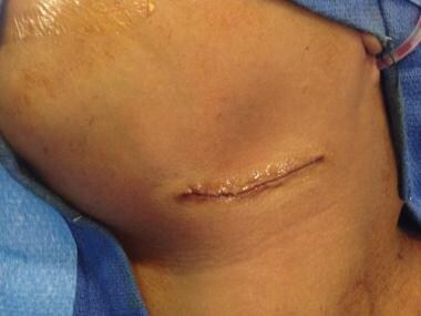 Appearance of incision immediately after applicati