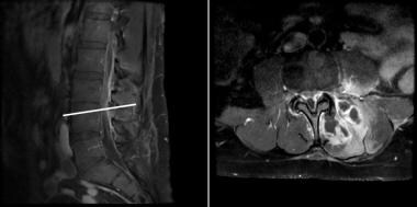 An MRI of the lumbar spine (T1-weighted, post-cont
