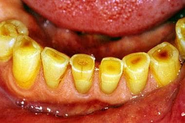 Image demonstrates dental attrition in a 75-year-o
