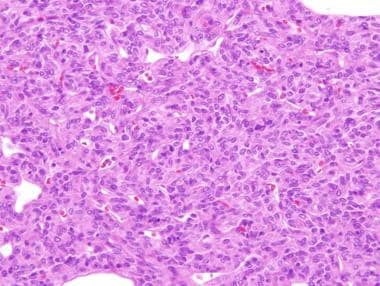 Histology of solitary fibrous tumor demonstrates a