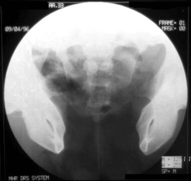 Wide diastasis of the pubic bone and external disp