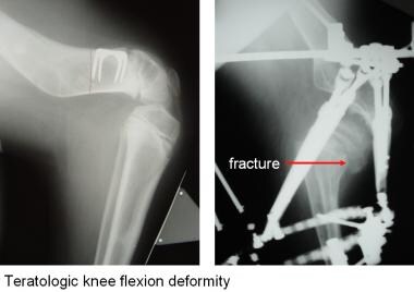 This girl born with a teratologic knee flexion def