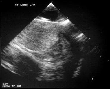 This scrotal sonogram shows intratesticular hemato