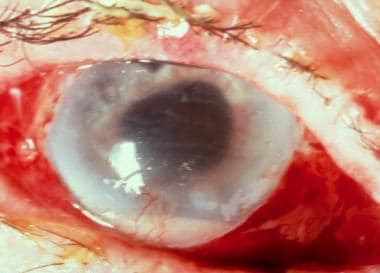 Severe endophthalmitis. Courtesy of Ron Afshari Ad