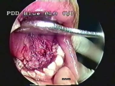 Floor of mouth, as seen after bilateral submandibu