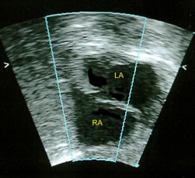 This 2-dimensional echocardiogram in an infant (su
