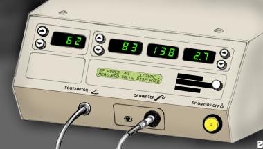 Radiofrequency ablation console (VNUS Medical Tech