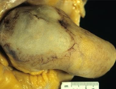 Thoracic Aortic Aneurysm Pathology. The heart of a