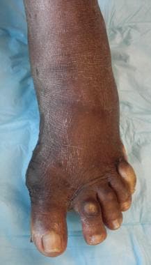 Chevron osteotomy to correct severe hallux valgus