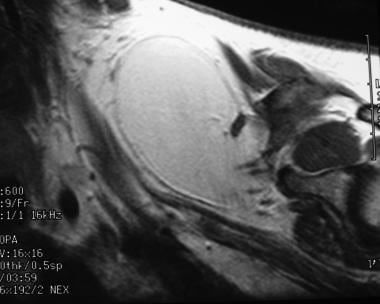 Brachial plexus injury. Lipoma in a 38-year-old wo