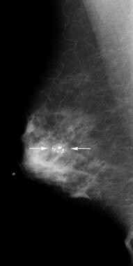This mass with associated large, coarse calcificat