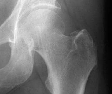 Radiograph depicting a Garden II hip fracture. 