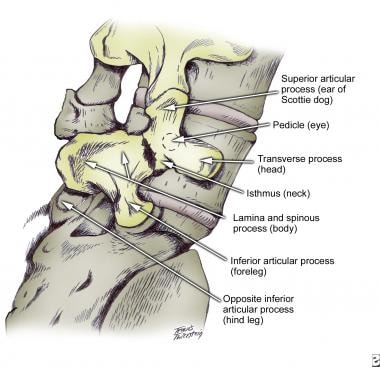 Spondylolisthesis. Diagram in the oblique projecti