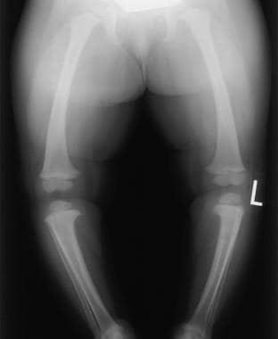 Infantile Blount disease. Radiograph in a 21-month